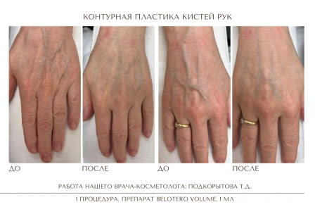 До и после: Контурная пластика Радиес / Radiesse, врач Подкорытова Т. Д., через 1 месяц после процедуры